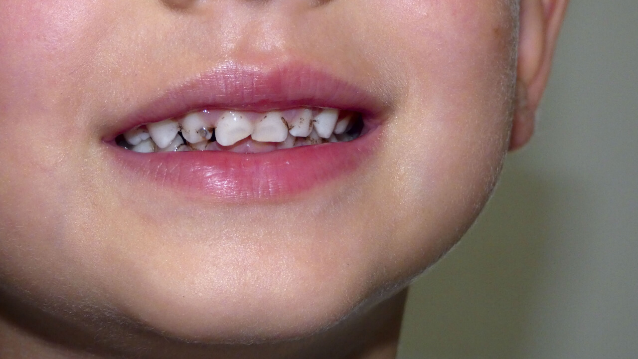 3 year old tooth decay treatment