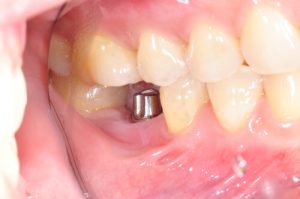 dental implant healing time