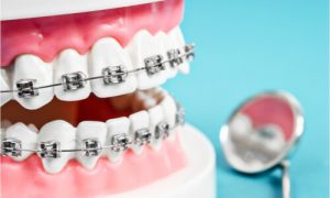 dental teeth model wearing traditional metal braces