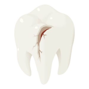 tooth chipped at gum line no pain